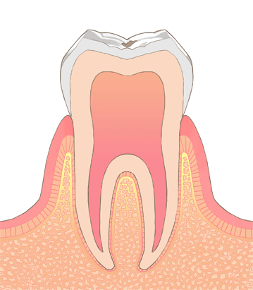CO（初期のむし歯）