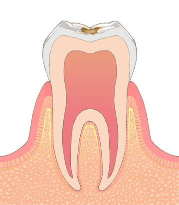 C1（エナメル質の虫歯）