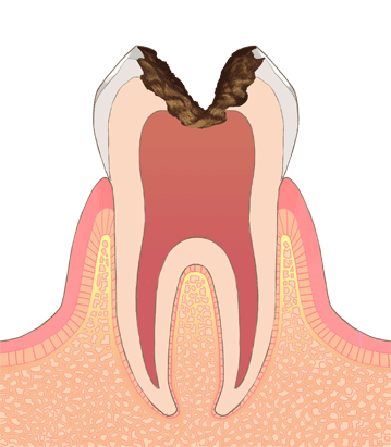 C3（神経の虫歯）
