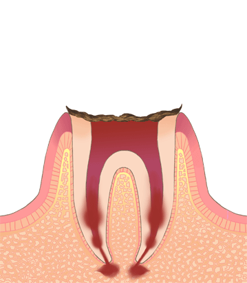 C4（歯根の虫歯）