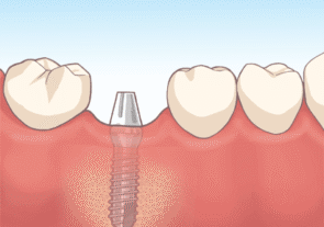 インプラント埋入手術