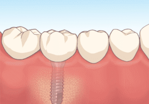 上部構造の製作・装着