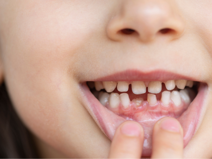 子供の歯並びは自然に治ることがある?